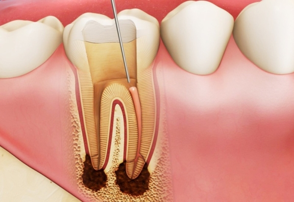 Nếu không được điều trị đúng cách, sưng nướu do răng khôn có thể dẫn tới viêm tủy răng