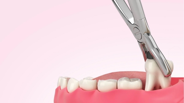 Nhổ bỏ hoàn toàn răng khôn để điều trị hiệu quả tình trạng sưng nướu