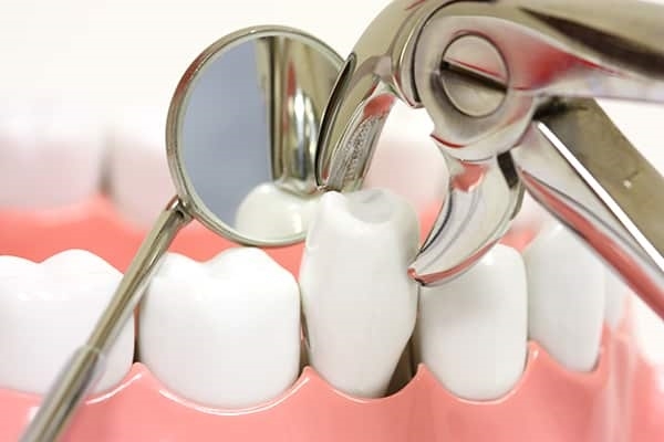 Khi nào nên và không nên nhổ răng?