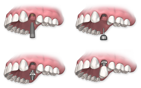 Khoảng thời gian từ 3-4 tháng sau khi nhổ răng cũng được xem là thời điểm phù hợp để tiến hành cấy ghép implant