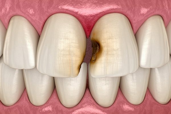 Sâu kẽ răng là tình trạng sâu răng xảy ra ở kẽ hở giữa các răng