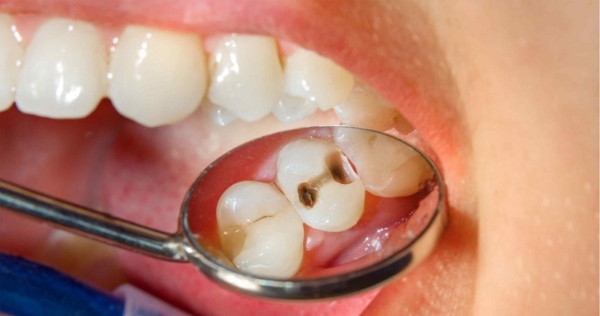 Nguyên nhân chủ yếu dẫn đến sâu kẽ răng là do vệ sinh răng miệng kém