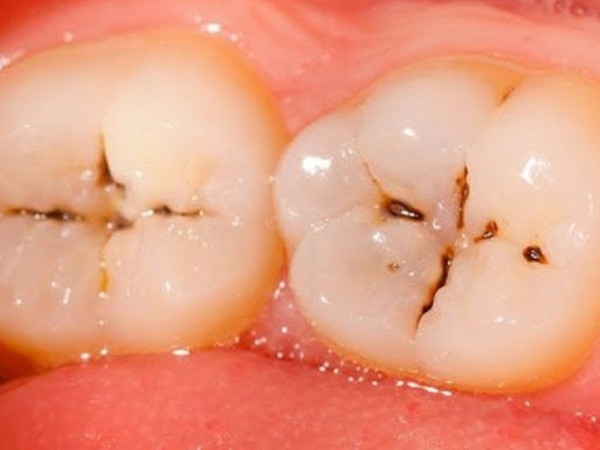 Kẽ giữa 2 răng cối hàm dưới: đây là vị trí hay gặp sâu kẽ răng nhất