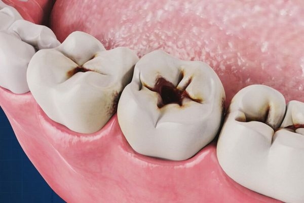 Về cơ bản sâu kẽ răng và sâu răng thông thường có nhiều điểm tương đồng