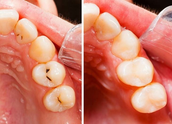 Điều trị sớm sâu kẽ răng ở giai đoạn đầu sẽ giúp phục hồi nhanh chóng
