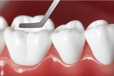Trám răng là một trong những phương pháp điều trị sâu kẽ răng phổ biến
