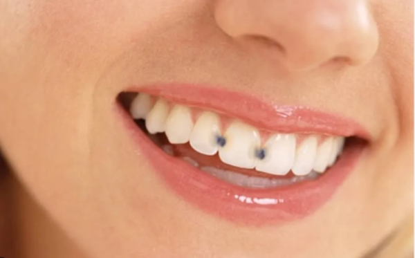 Sâu kẽ răng cửa là tình trạng sâu xảy ra ở kẽ giữa các răng, phổ biến nhất là kẽ giữa răng cửa và răng tiền hàm