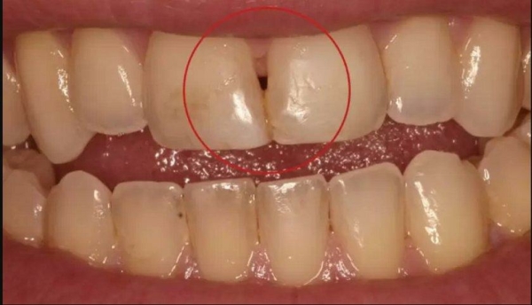 Kẽ răng cửa rất hẹp khó có khả năng vệ sinh sạch sẽ so với các bề mặt răng khác
