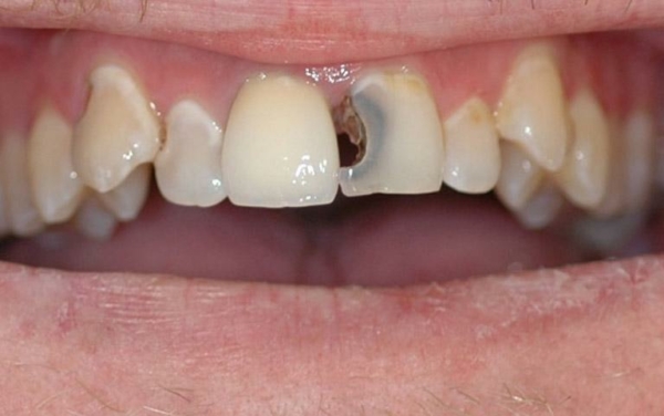 Viêm tủy răng là một biến chứng nguy hiểm thường gặp khi sâu răng cửa
