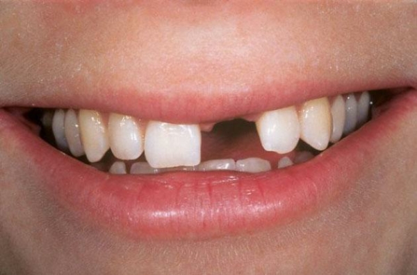 Mất răng là một trong những biến chứng của sâu răng cửa