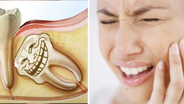 Răng khôn gây ra tình trạng đau nhức dữ dội và sưng tấy vùng hàm, là nguyên nhân dẫn đến nhiều vấn đề nguy hiểm cho răng miệng