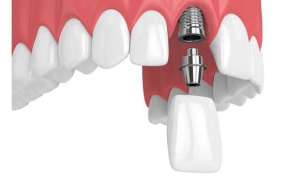 Trồng răng cửa bằng phương pháp cấy ghép implant được đánh giá là tốt nhất hiện nay