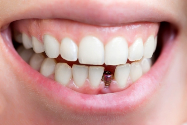 Chi phí trồng 2 răng cửa là bao nhiêu?