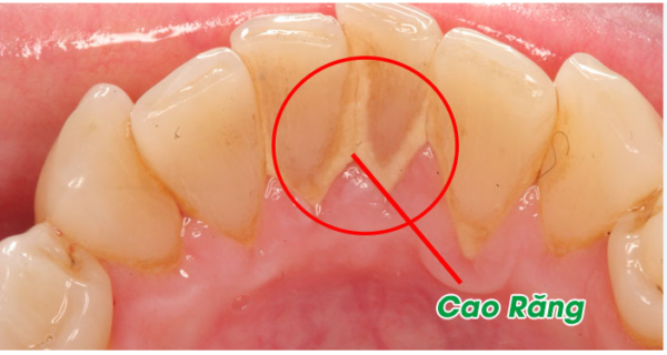 Cao răng là các mảng bám màu vàng nâu hoặc trắng đục bám chặt vào bề mặt răng