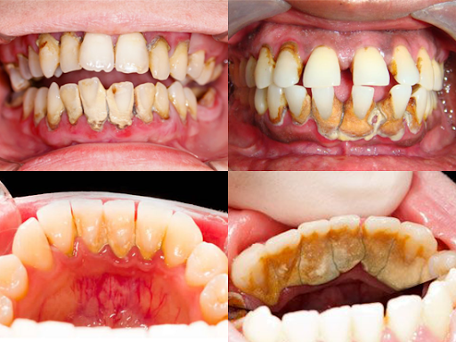 Cao răng gây ra vô vàn tác hại nghiêm trọng cho răng và sức khỏe