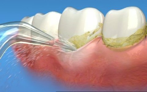 Lấy cao răng định kỳ sẽ giúp loại bỏ mảng bám, làm sạch răng miệng