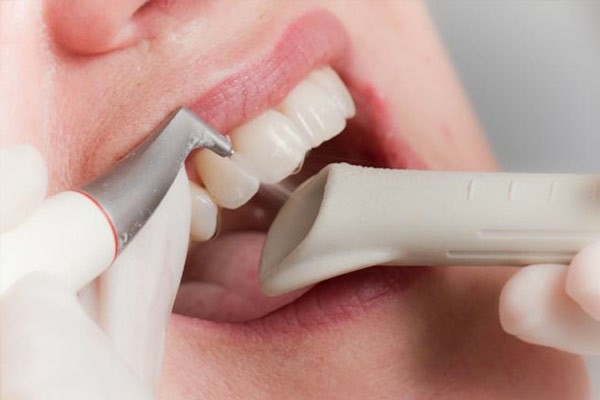 Lấy cao răng thường xuyên sẽ góp phần phòng tránh sâu răng và hôi miệng