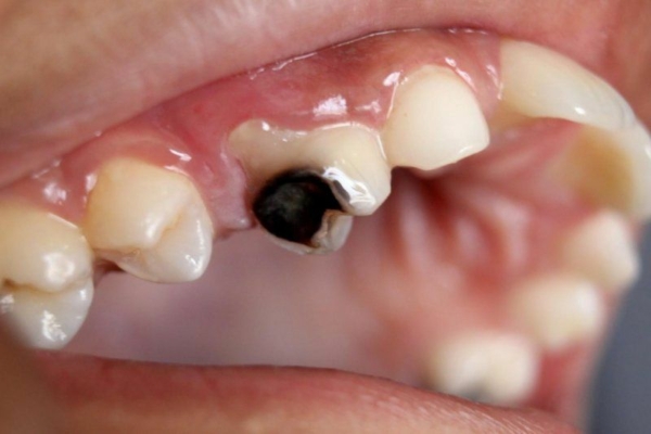Sâu răng lâu ngày dẫn đến chân răng bị mục