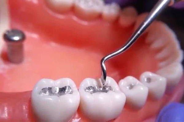 Có nhiều phương pháp điều trị chân răng bị mục như trám, bọc răng sứ, nhổ bỏ,..