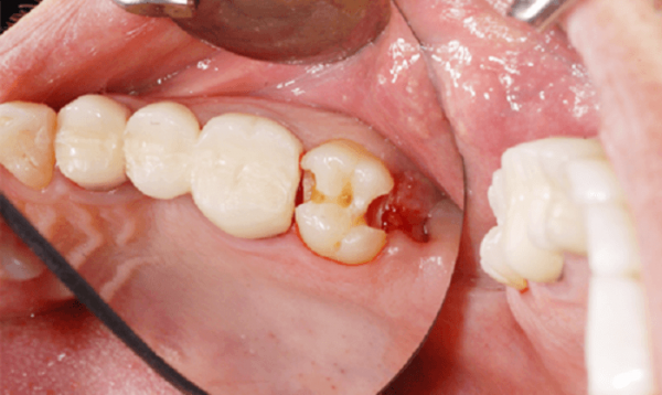 Sâu răng kéo dài chính là nguyên nhân phổ biến gây nên tình trạng răng bị lồi thịt