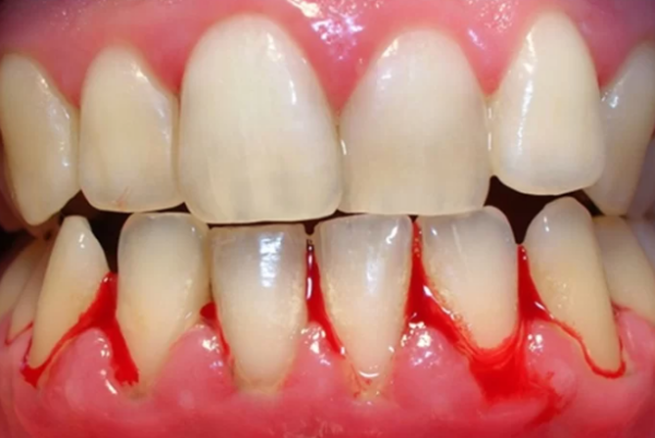 Khi lợi bị tụt xuống, nướu dễ chảy máu khi đánh răng hoặc khi ăn uống