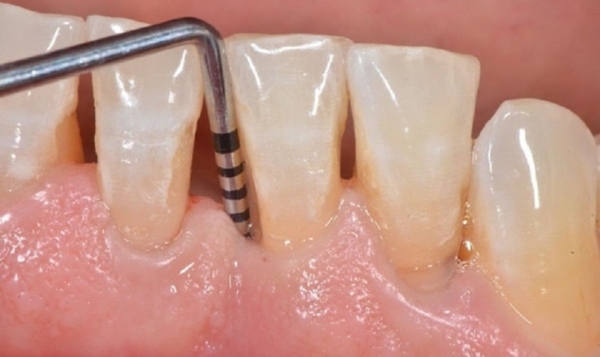 Can thiệp phẫu thuật để khôi phục lại chức năng và thẩm mỹ cho hàm răng khi lợi bị tụt ở giai đoạn nặng