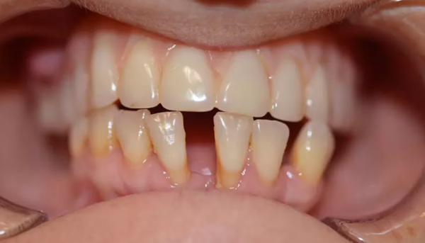 Bất thường về kích thước xương hàm dưới là một trong những nguyên nhân gây ra tình trạng răng thưa.