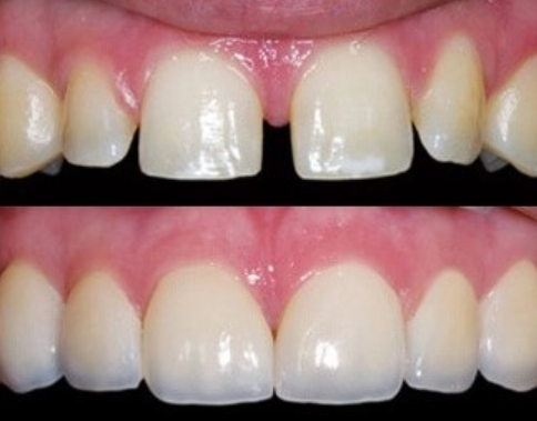 Hàn trám răng bằng composite để xử lý tình trạng răng thưa