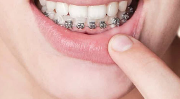 Niềng răng được xem là phương pháp điều trị răng thưa hàm dưới triệt để