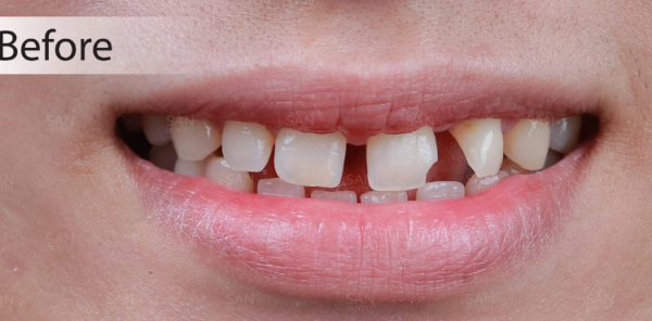Trường hợp một hàm bị răng thưa nhưng hàm còn lại vẫn đầy đủ răng
