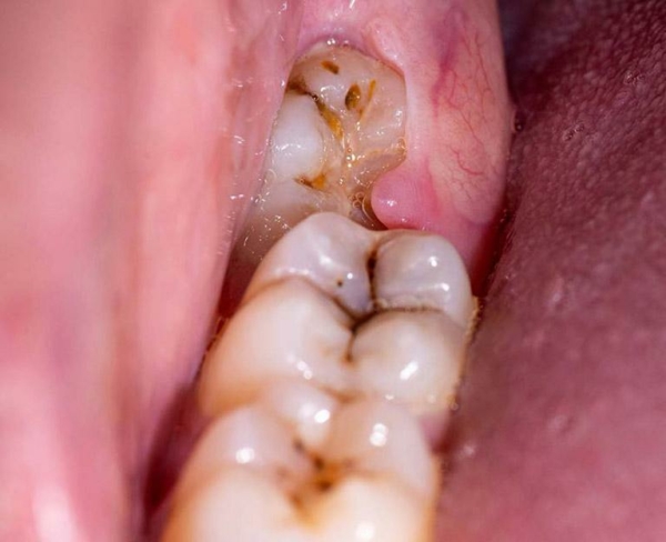Các bệnh lý về răng miệng là nguyên nhân phổ biến nhất gây nên áp xe má