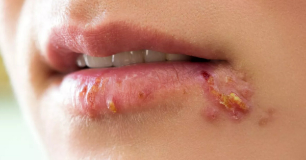 Herpes môi là bệnh nhiễm trùng phổ biến ở vùng môi và miệng, do virus herpes simplex (HSV) gây ra