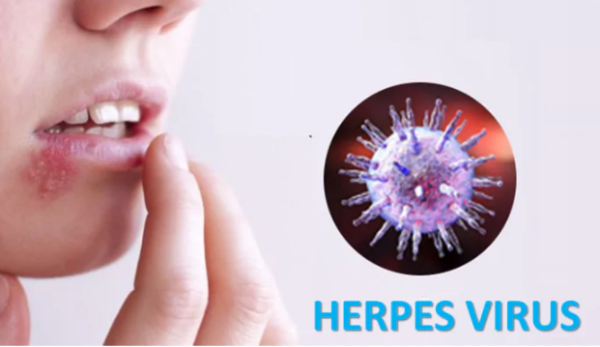 Nguyên nhân chính gây nên bệnh herpes môi là do sự nhiễm trùng của virus herpes simplex (HSV)