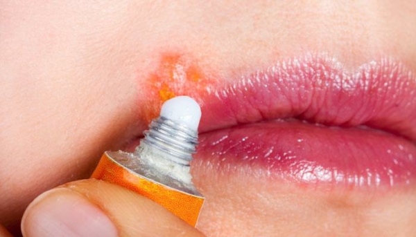 Sử dụng thuốc để điều trị bệnh herpes môi