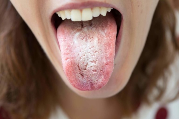 Khi bị tưa lưỡi, người bệnh thường xuất hiện các rối loạn về vị giác và cảm giác đắng trong miệng