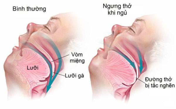 Bệnh nhân ngưng thở khi ngủ rất dễ bị chảy nước miếng về đêm