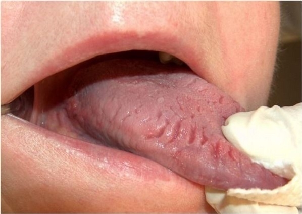 Nứt lưỡi nếu không được điều trị kịp thời có thể dẫn đến các biến chứng nguy hiểm