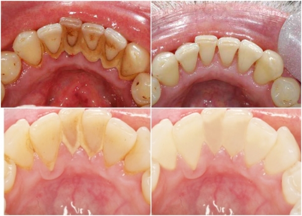 Tủy vào tình trạng răng mà giá cạo vôi và tẩy trắng răng sẽ có sự chênh lệch