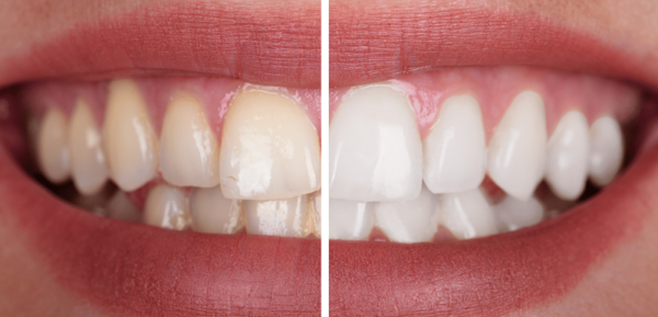 Cạo vôi và tẩy trắng răng giúp tăng tính thẩm mỹ rõ rệt thông qua việc làm trắng sáng và đều màu răng