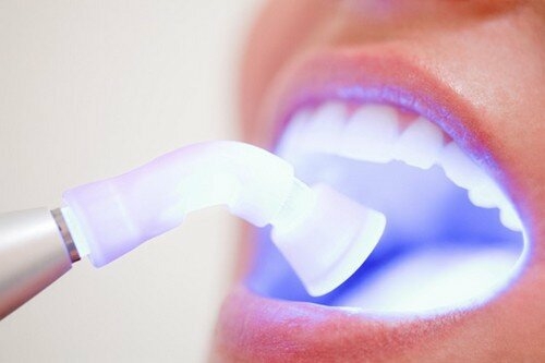 Laser Whitening tiết kiệm được rất nhiều thời gian