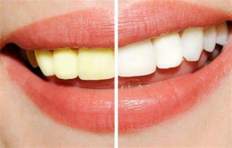 Laser Whitening mang lại kết quả tẩy trắng vượt trội so với các phương pháp thông thường