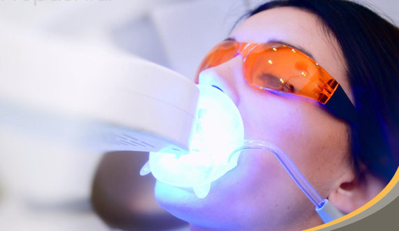 Chiếu tia Laser Whitening để tẩy trắng răng