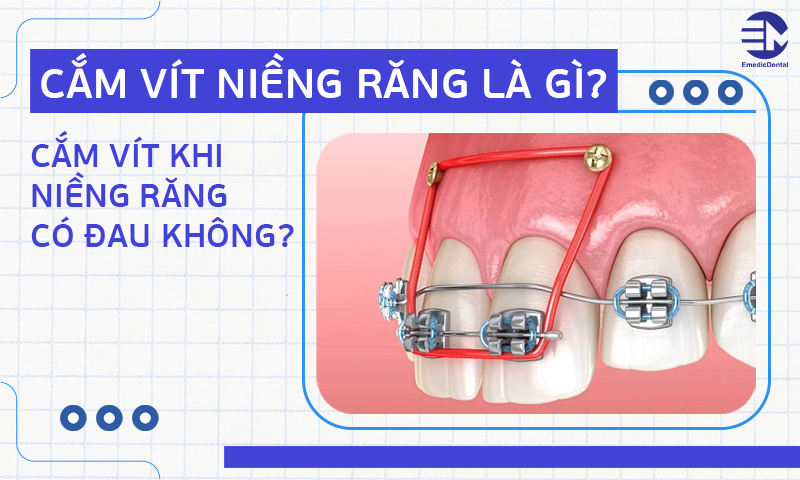 Cắm vít niềng răng là gì? Cắm vít khi niềng răng có đau không?