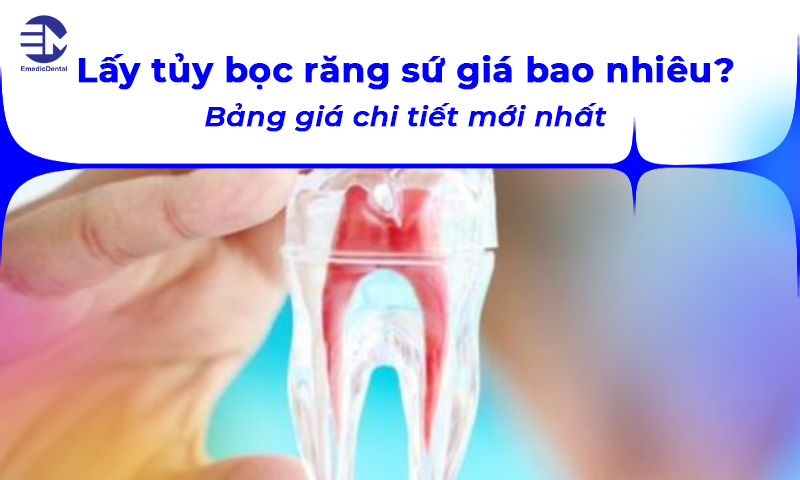 Lấy tủy bọc răng sứ giá bao nhiêu? Bảng giá chi tiết mới nhất