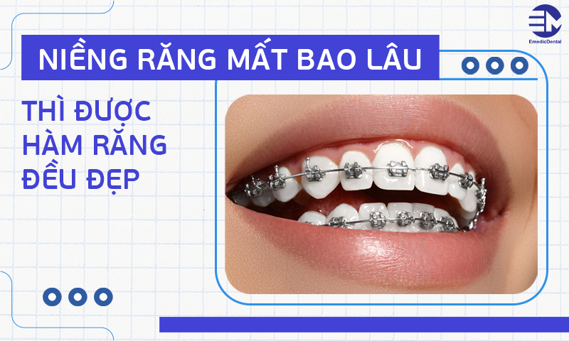 Niềng răng mất bao lâu thì được hàm răng đều đẹp