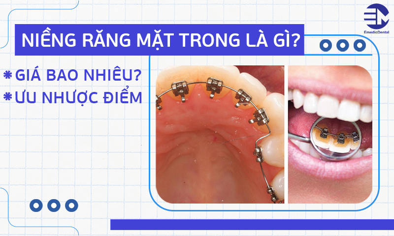 Niềng răng mặt trong là gì? Giá bao nhiêu? Ưu nhược điểm