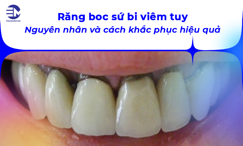 Răng bọc sứ bị viêm tủy: Nguyên nhân và cách khắc phục hiệu quả