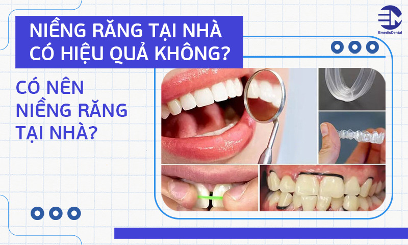 Niềng răng tại nhà có hiệu quả không?