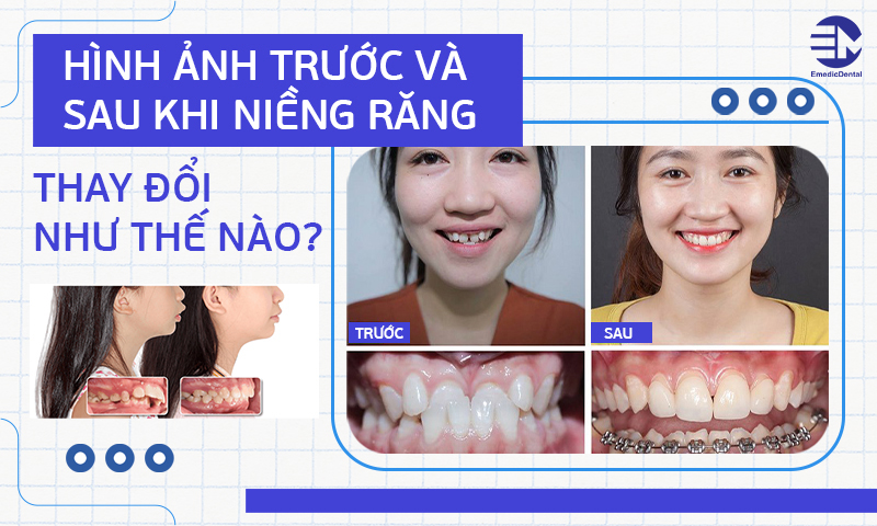 Hình ảnh trước và sau khi niềng răng thay đổi như thế nào?