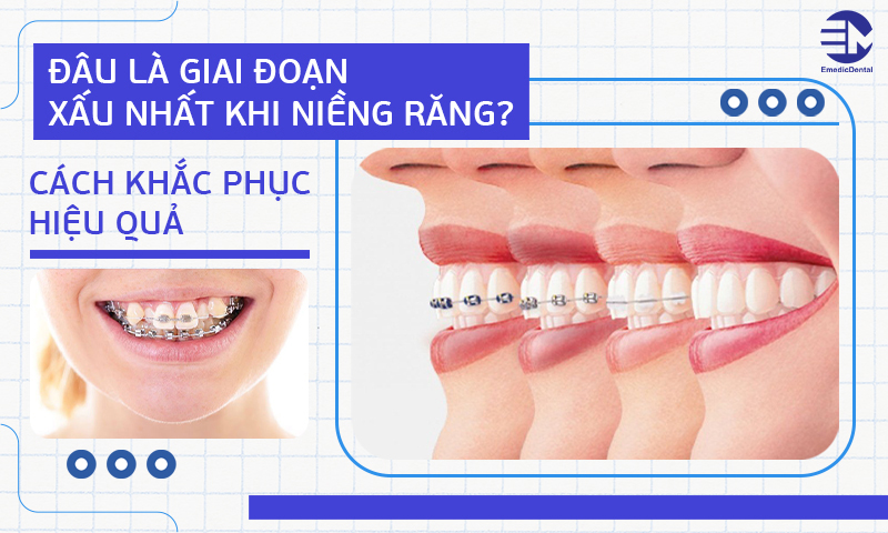 Đâu là giai đoạn xấu nhất khi niềng răng? Cách khắc phục hiệu quả